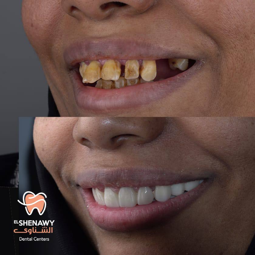 تجميل الاسنان قبل وبعد