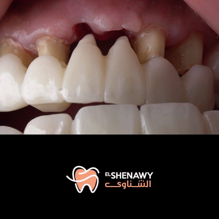 علاج تآكل الأسنان من الجذور