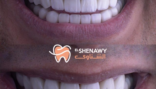 تحسين مظهر أسنانك مع فينير الأسنان المتحرك