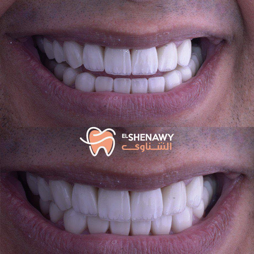 تحسين مظهر أسنانك مع فينير الأسنان المتحرك
