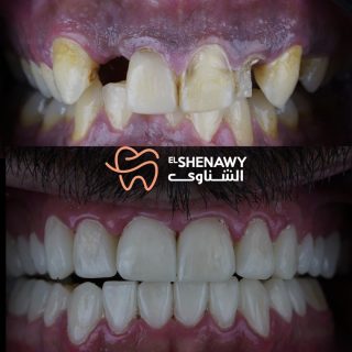 علاج السن المكسور