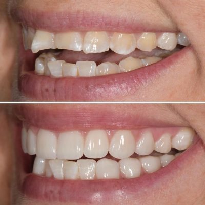 طربوش الاسنان الامامية