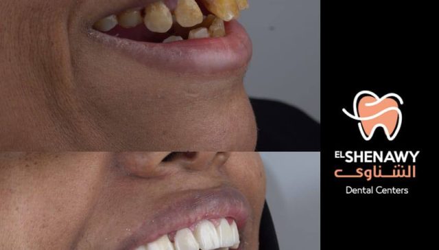 زراعة الأسنان الفورية في السعودية