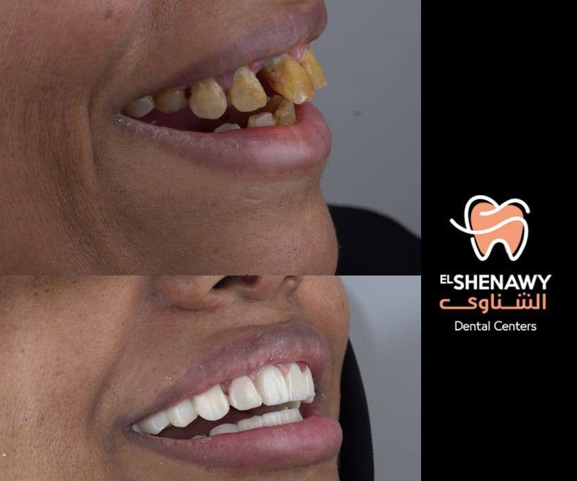 زراعة الأسنان الفورية في السعودية