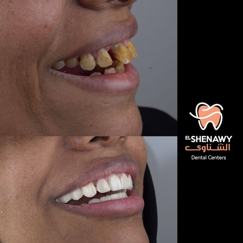 زراعة الأسنان الفورية في السعودية