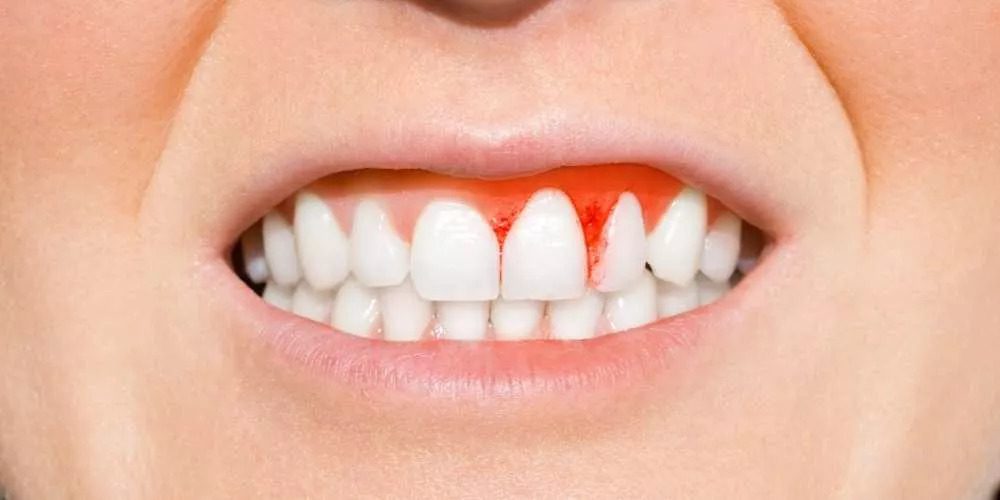 لتهاب اللثة بعد زراعة الأسنان