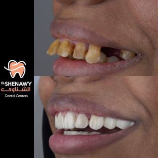 تسوس الأسنان الأمامية