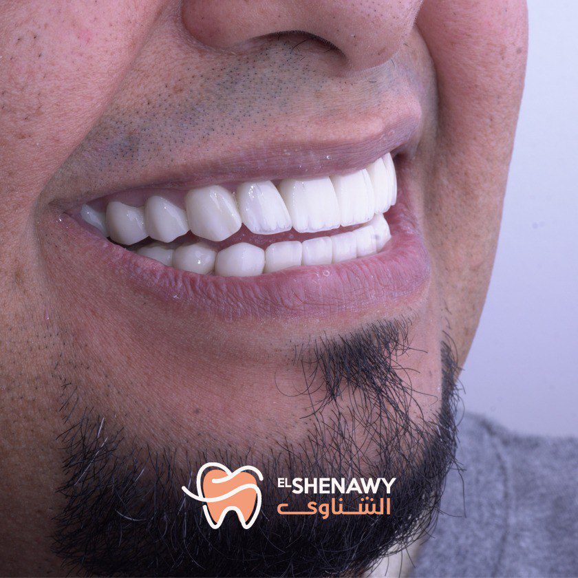 اسباب نزيف اللثة