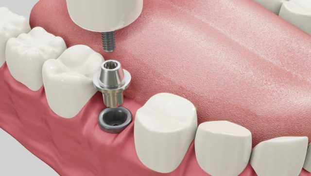 bone grafting for teeth