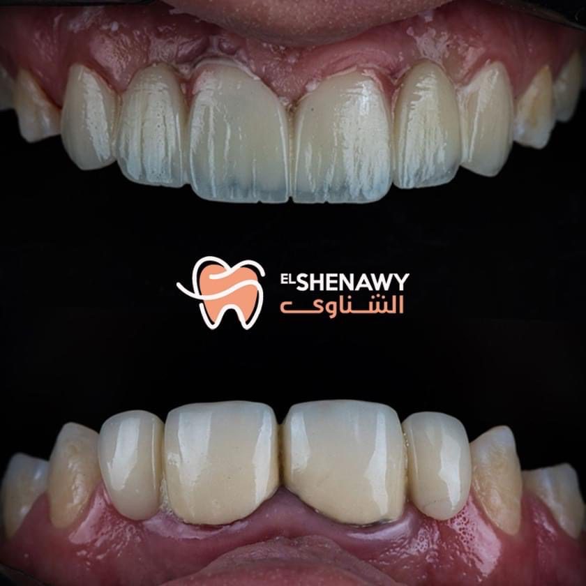 علاج التهاب عصب الضرس