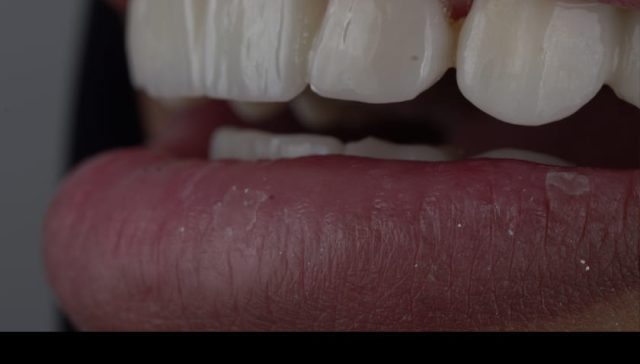 حشو الاسنان