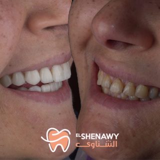 طرق ازالة تصبغات الاسنان