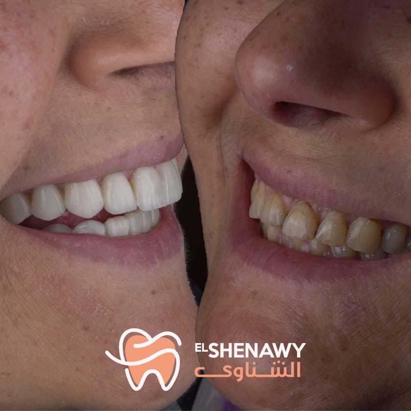 طرق ازالة تصبغات الاسنان