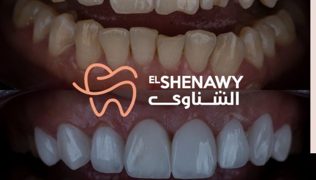 فينير الاسنان