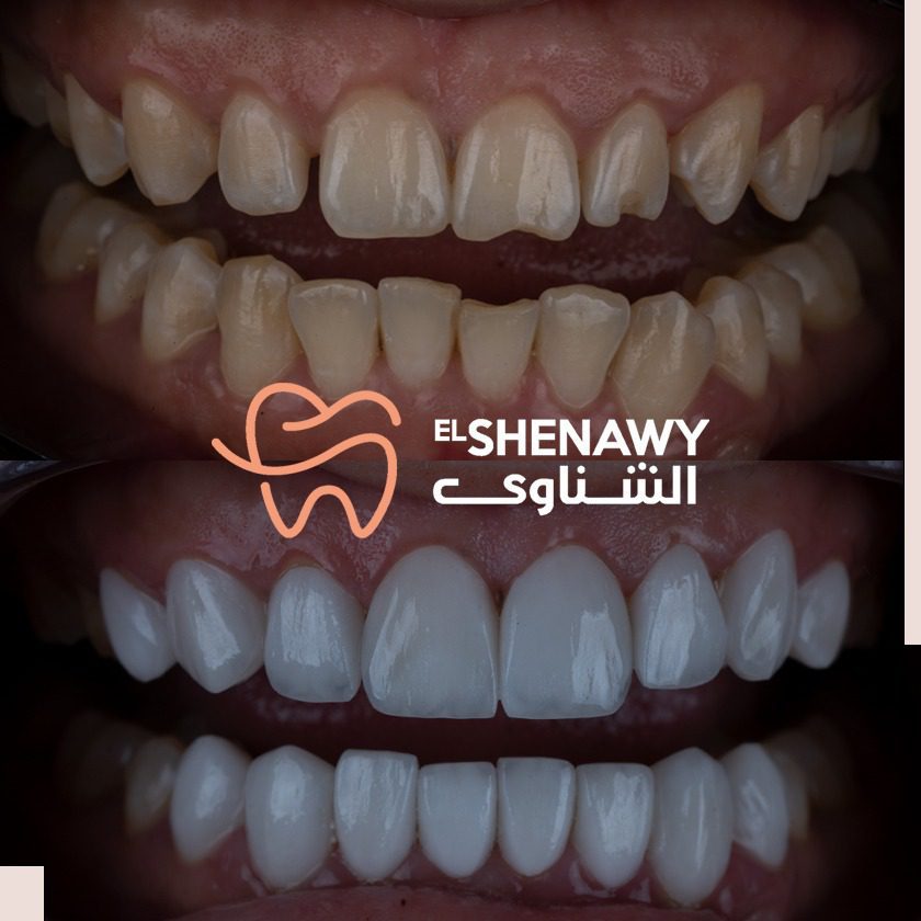 فينير الاسنان