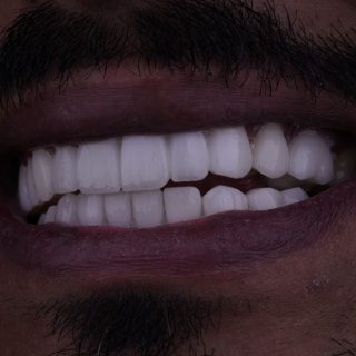 Prices of Dental Veneers in Egypt