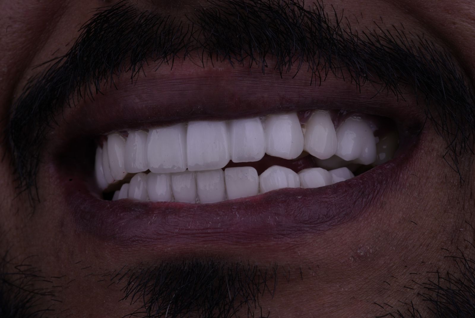 Prices of Dental Veneers in Egypt