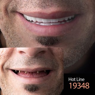 ارخص اسعار زراعة الأسنان