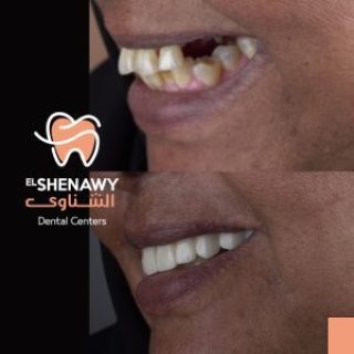 اسباب اعوجاج الاسنان