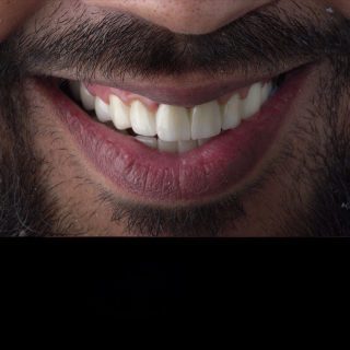 teeth whitening egypt