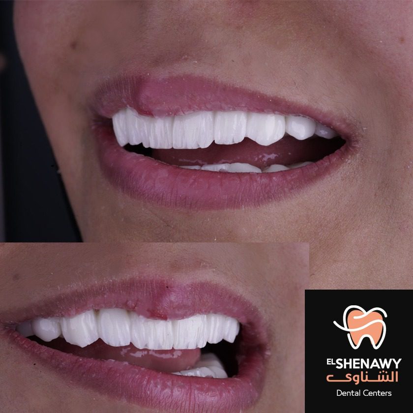 انواع هوليود سمايل