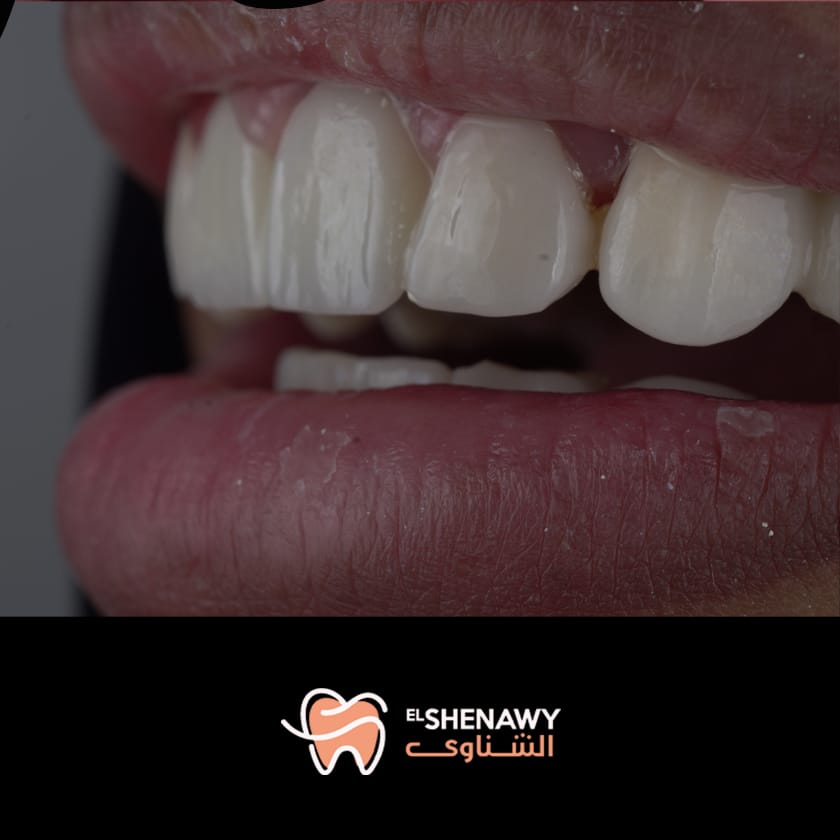 أنواع تيجان الأسنان الأمامية