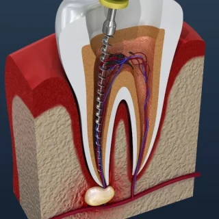 root canal treatment