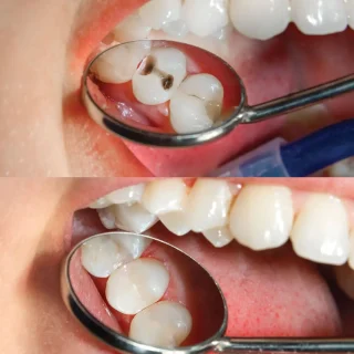 حشو الضرس عصب