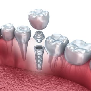 Dental Implant for One Tooth