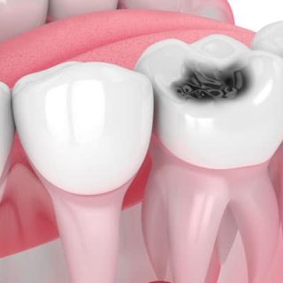 tooth cavity treatments