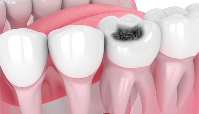 tooth cavity treatments
