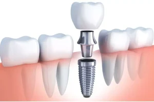 procedure for dental implants