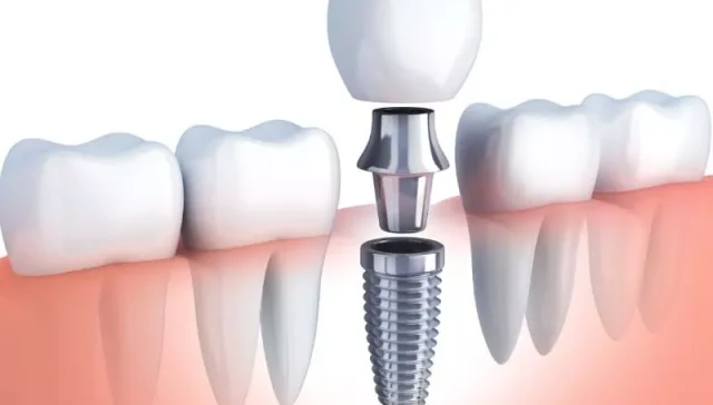 procedure for dental implants