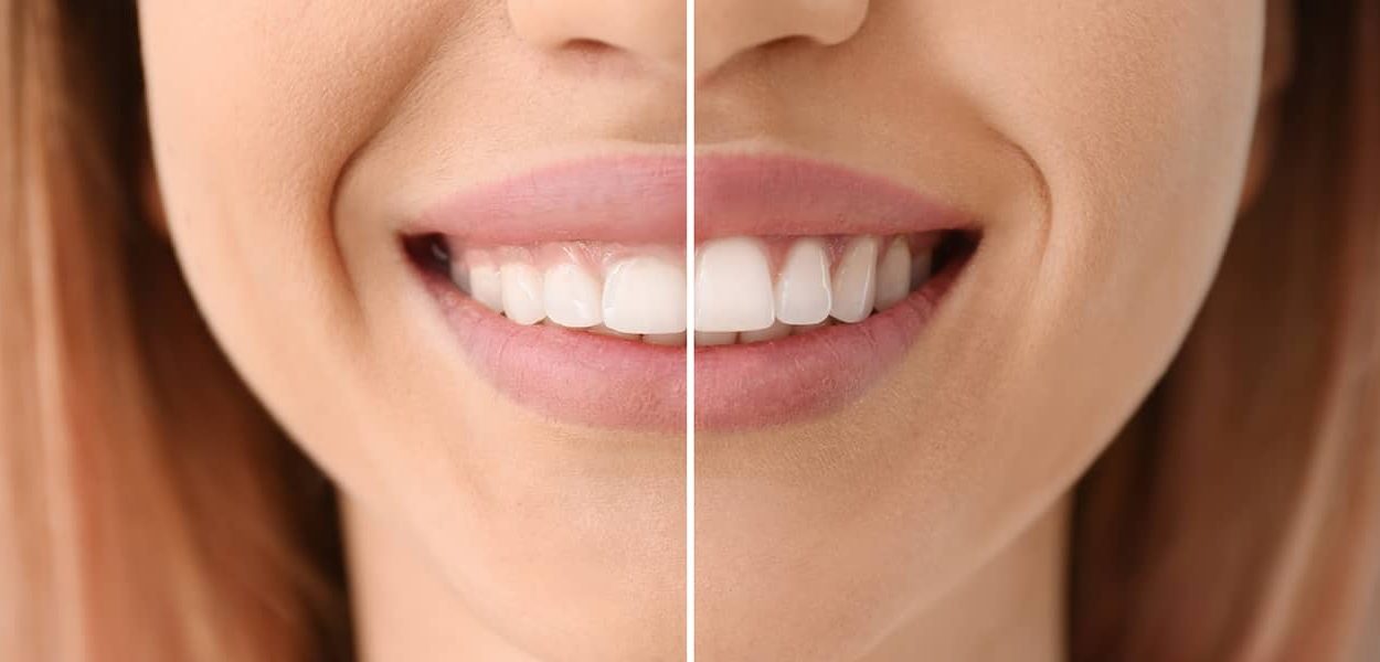 gummy smile correction without surgery