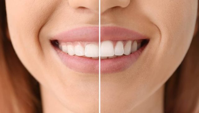 gummy smile correction without surgery