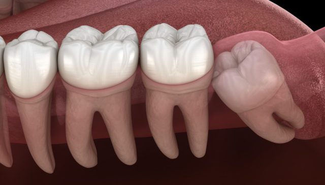 wisdom tooth removal