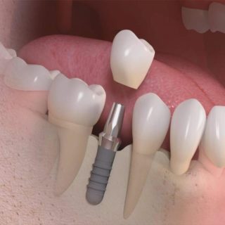 تركيب دعامة الضرس