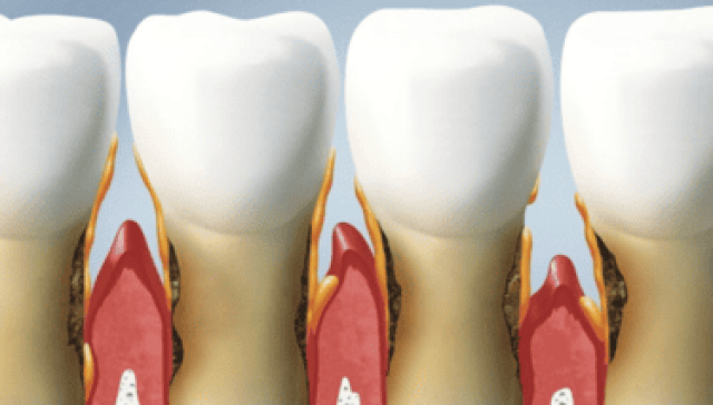 Losing Bone Around Teeth