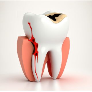 Exposed Nerve in Tooth