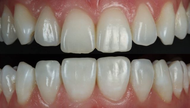 Composite Resin Bonding