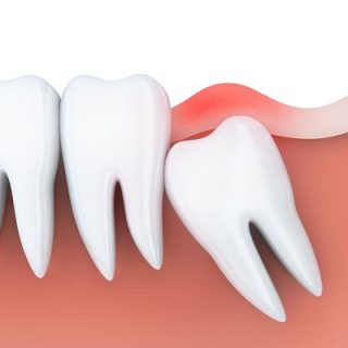 Wisdom Molar Extraction