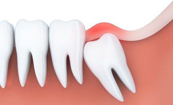 Wisdom Molar Extraction