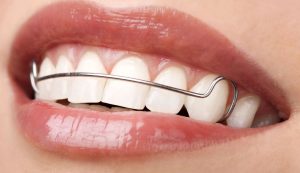 hawley orthodontic retainer