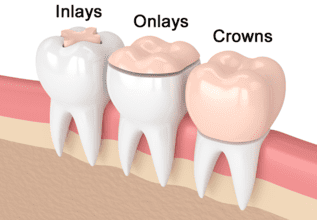 Composite Inlays and Onlays