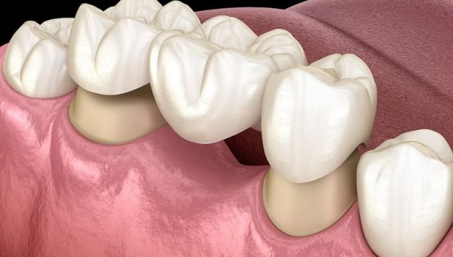 Cantilever Bridge Teeth