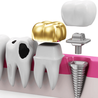 Restorative Dental Care