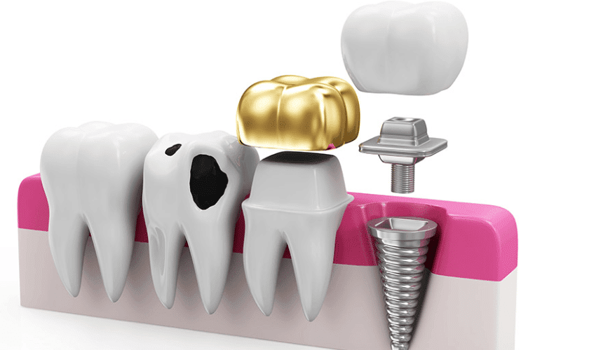 Restorative Dental Care