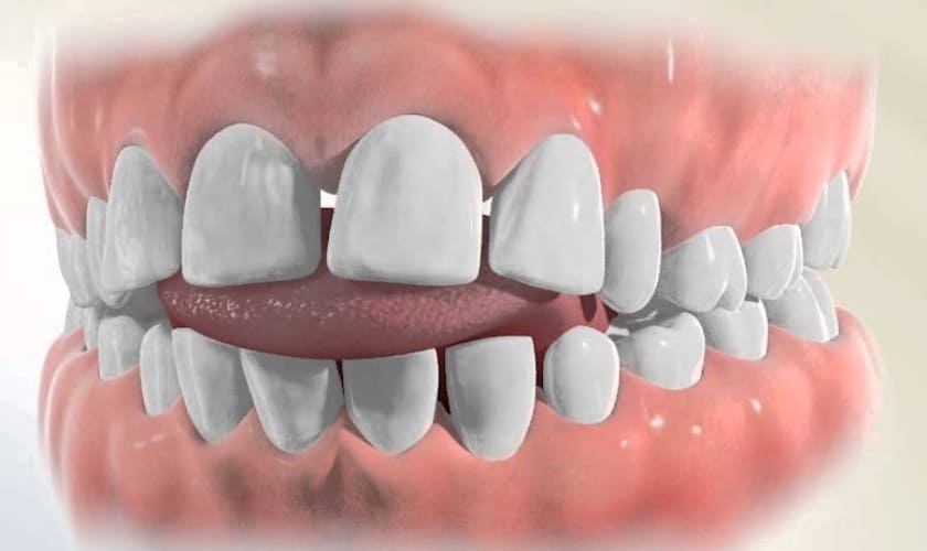 Thrusting of the Tongue