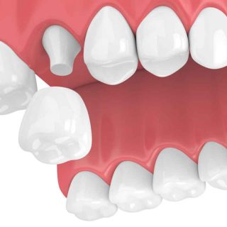 Dental Crown Falls Off