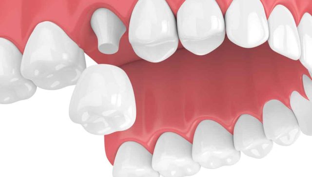 Dental Crown Falls Off